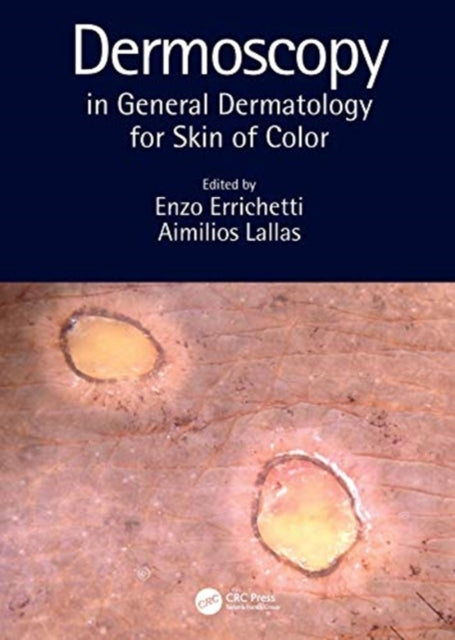 Dermoscopy in General Dermatology for Skin of Color - New Hardback